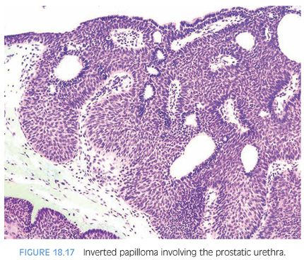 Prostatic Urethral Lesions | Basicmedical Key