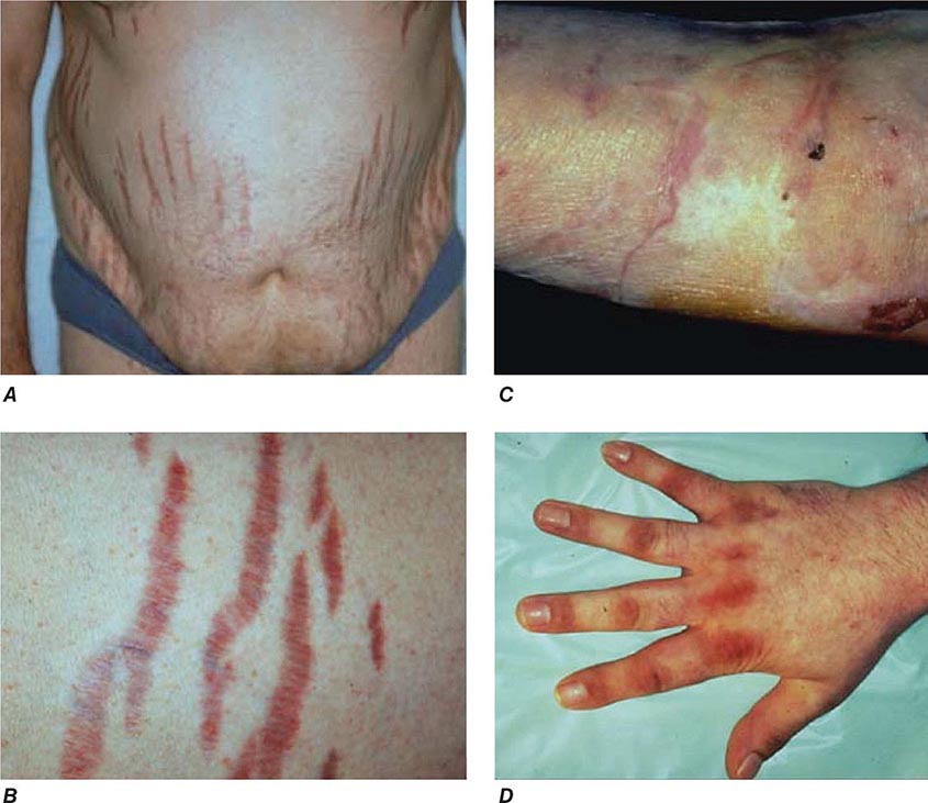 Autoimmune Polyendocrine Syndromes Basicmedical Key