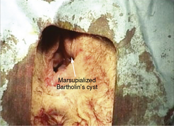 Bartholin’s Marsupialization | Basicmedical Key