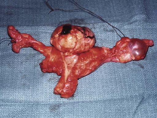 Gynecologic and Obstetric Surgery Basicmedical Key