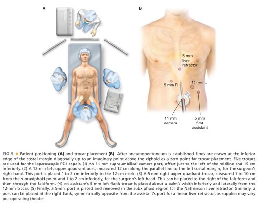 Paraesophageal Hernia Repair Laparoscopic Technique Basicmedical Key