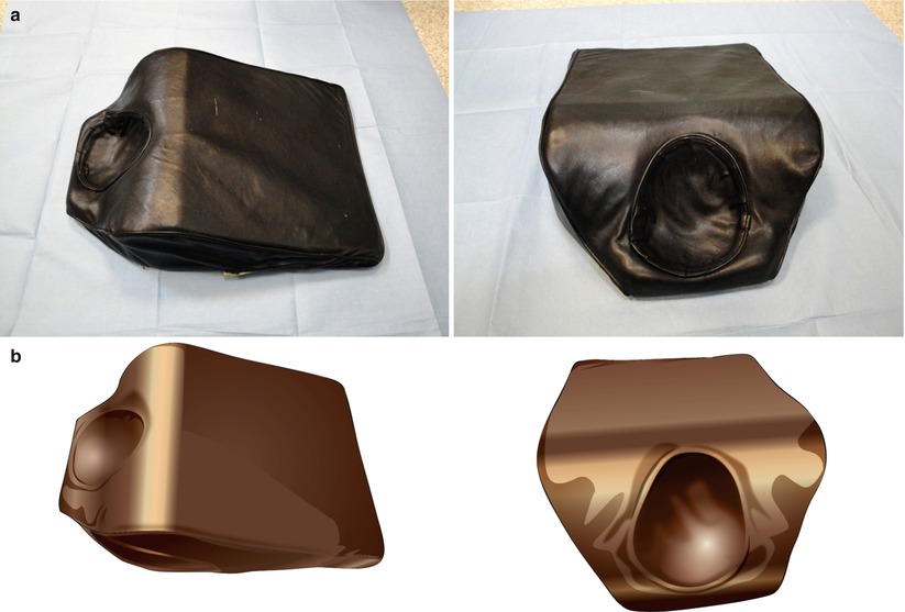 Open Thyroidectomy Basicmedical Key