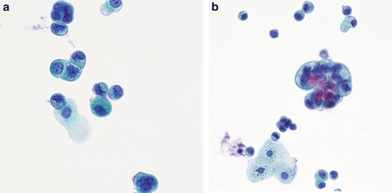 Atypical Urothelial Cells (AUC) Basicmedical Key