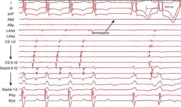 Supraventricular Tachycardia with Congenital Heart Disease Basicmedical Key