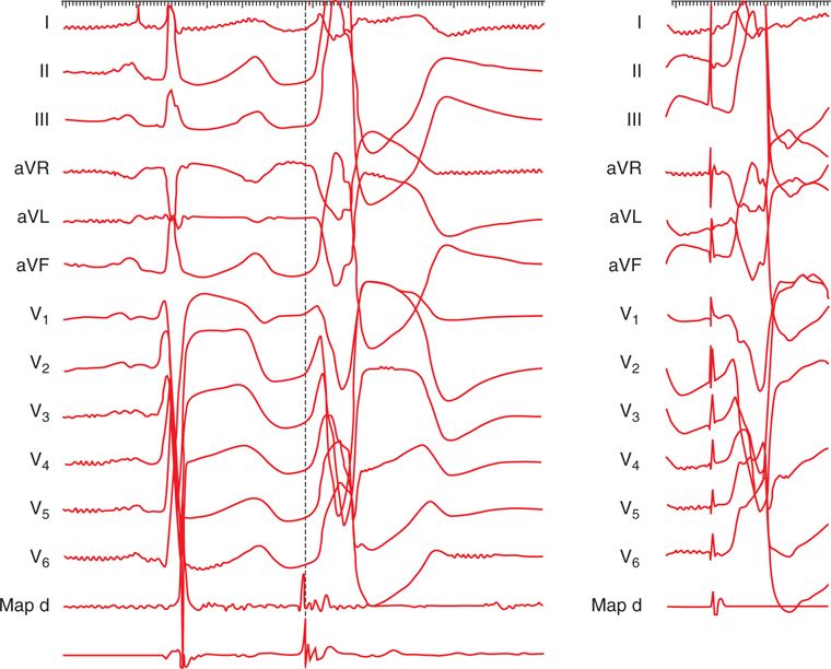 PVC and Cardiomyopathy Basicmedical Key
