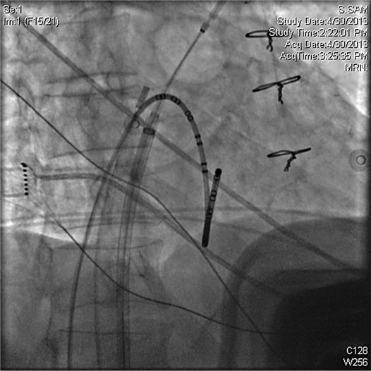 Approaches to Atrial Fibrillation Cryoablation Basicmedical Key