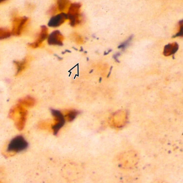 CatScratch Disease Basicmedical Key