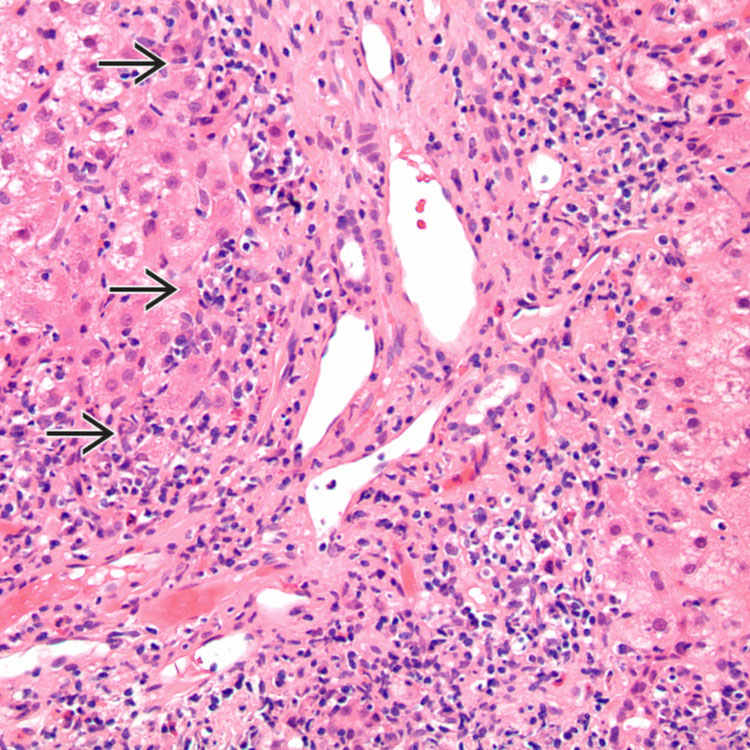 Autoimmune Hepatitis Basicmedical Key