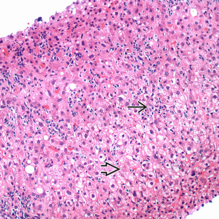 Autoimmune Hepatitis Basicmedical Key