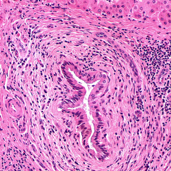 Primary Sclerosing Cholangitis Basicmedical Key