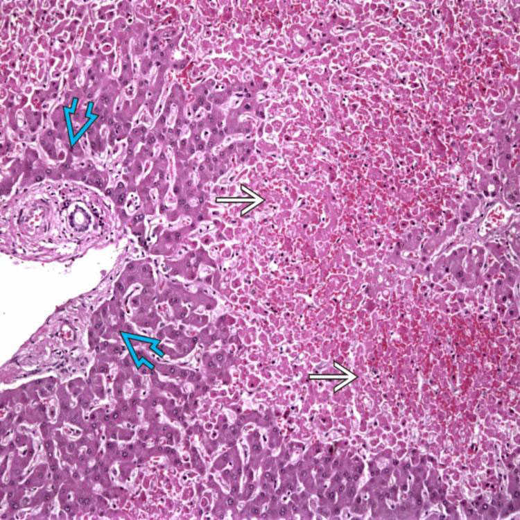 Ischemia Basicmedical Key