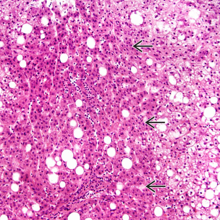 Regenerative and Dysplastic Nodules Basicmedical Key