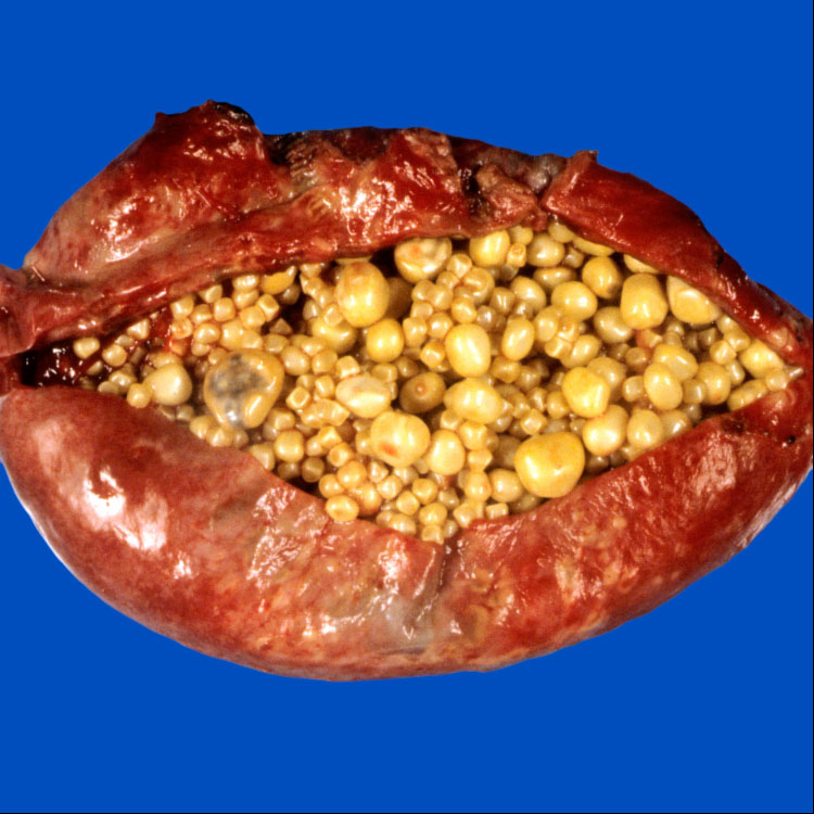 Cholelithiasis Basicmedical Key