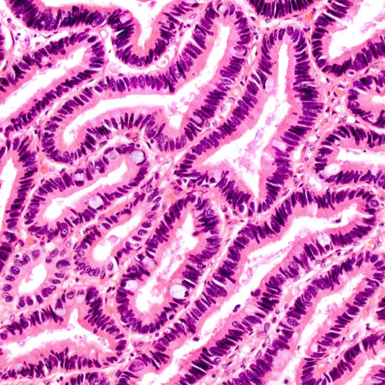 Intracholecystic PapillaryTubular Neoplasms Basicmedical Key
