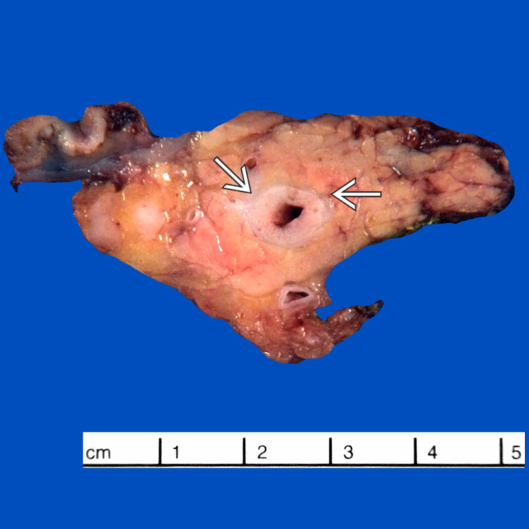 Adenocarcinoma of Extrahepatic Bile Ducts Basicmedical Key