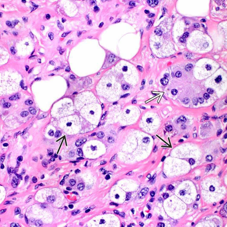 Neuroendocrine Tumors of Gallbladder Basicmedical Key