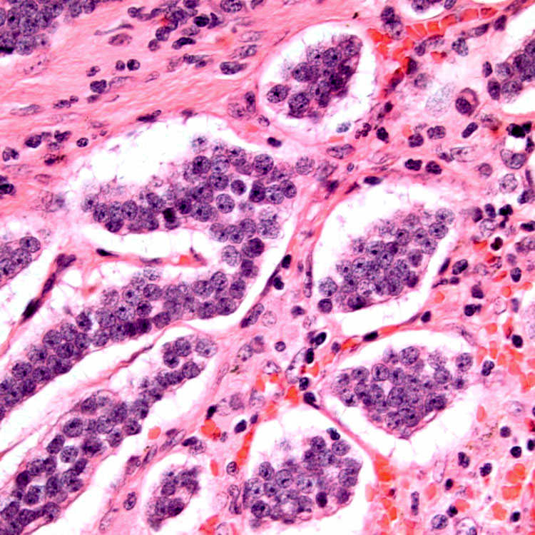 WellDifferentiated Neuroendocrine Tumor, Pancreas Basicmedical Key