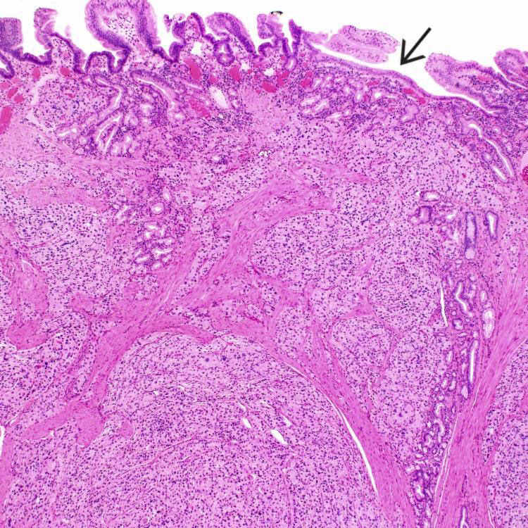 HormoneProducing (Neuroendocrine) Tumors at Bertha Doss blog