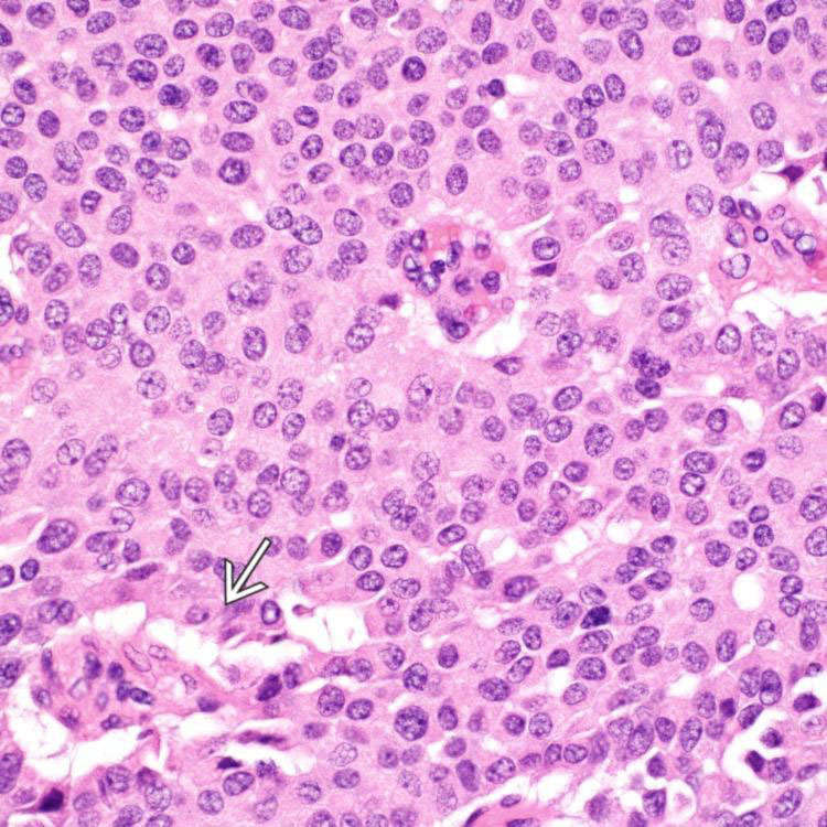 WellDifferentiated Neuroendocrine Tumor, Ampulla Basicmedical Key