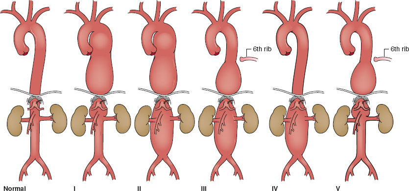 Thoracoabdominal Aortic Aneurysms | Basicmedical Key