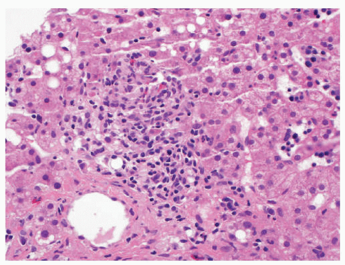 Granulomatous Liver Disease | Basicmedical Key