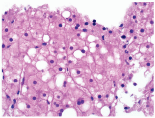 Fatty Liver Disease Alcoholic And Nonalcoholic Basicmedical Key