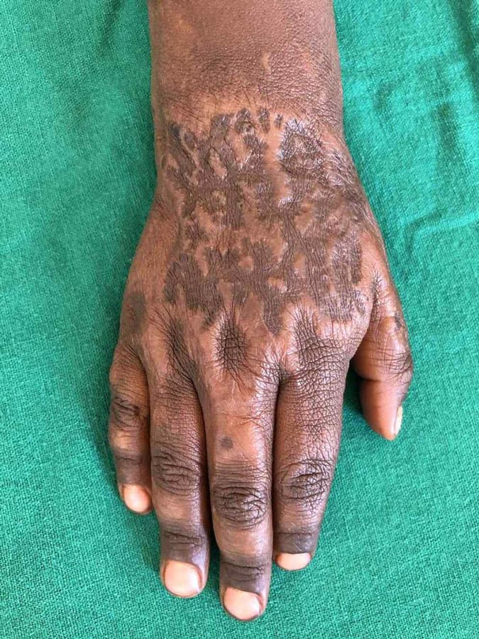 Types of burn scars Basics of Burn Care