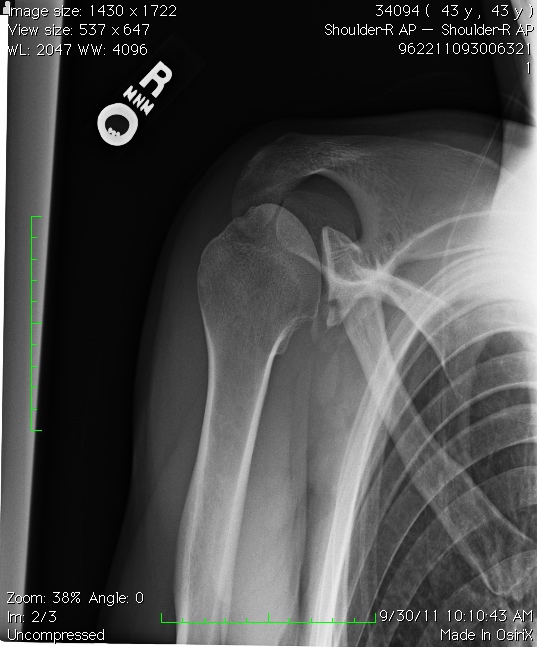 How Do You Treat a Shoulder Fracture? Baskin Clinic