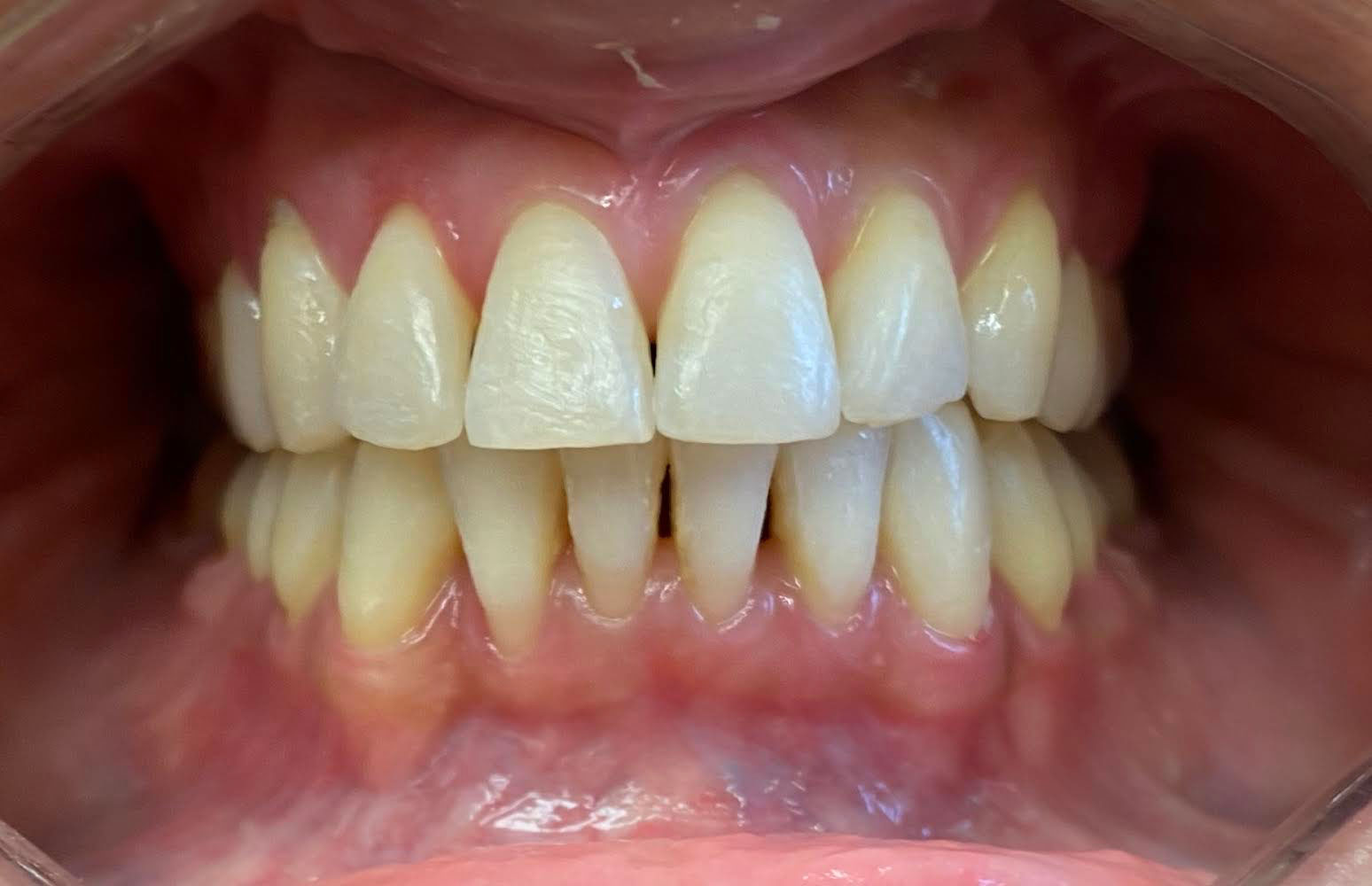 Dentistry Before and After Photos Basking Ridge Dental Group