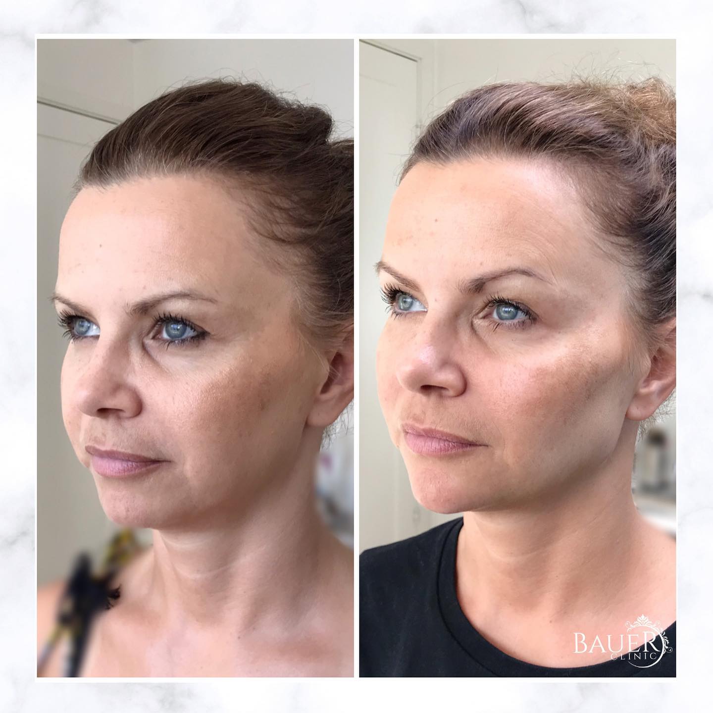 Fillers Stockholm Leg. specialistsjuksköterska Bauer Clinic
