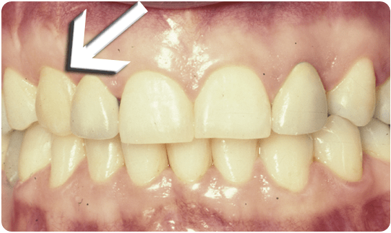 Tooth Exposure Dr Bernard Fialkoff