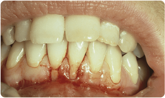 Soft Tissue Grafts Dr Bernard Fialkoff