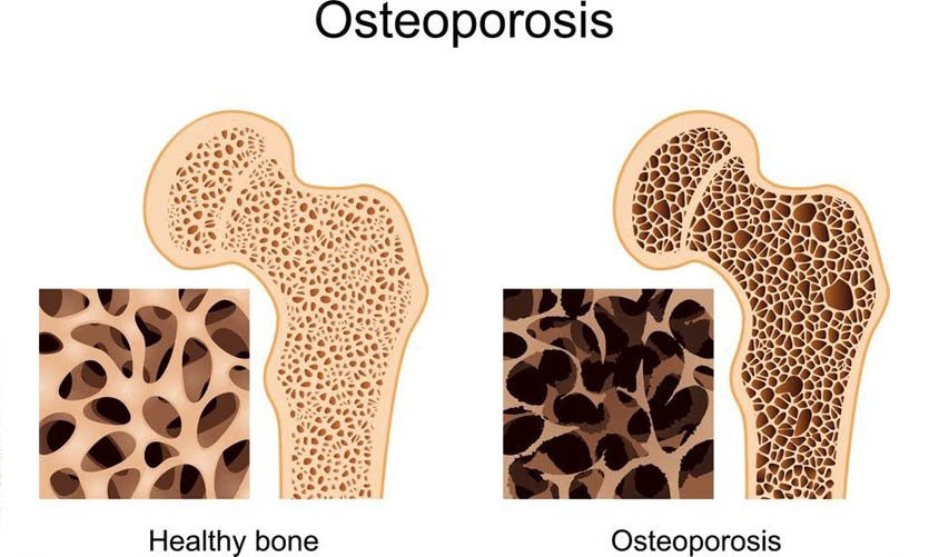 What is Osteoporosis? Balanced Body Chiropractic