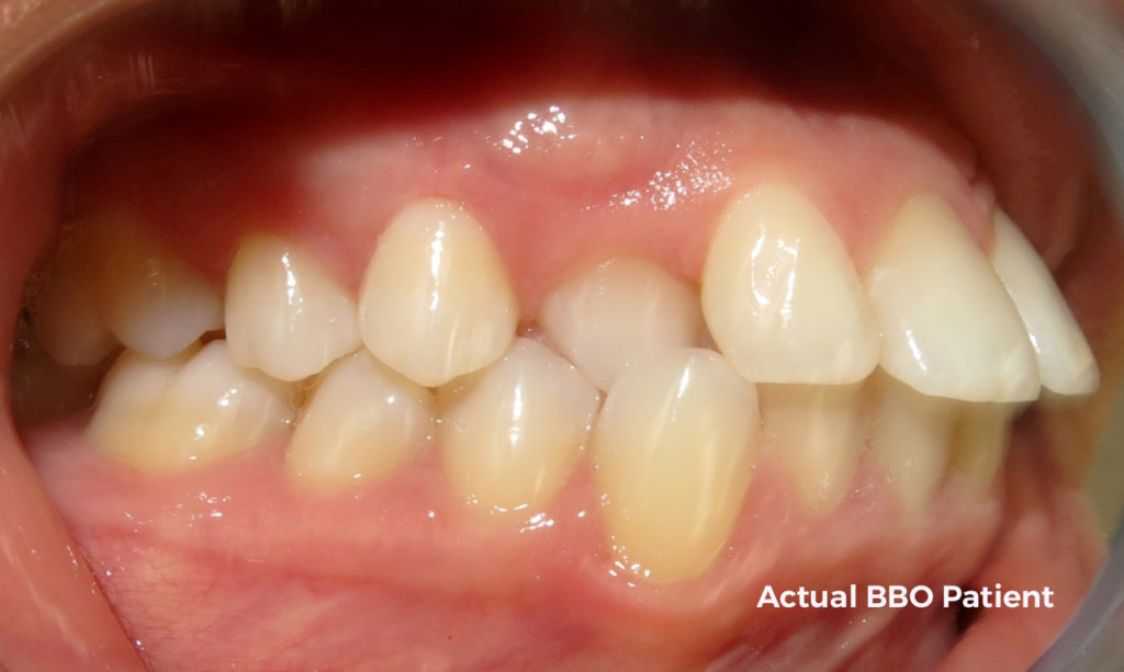 Adult Invisalign Protrusion/Crossbite Bridgham Barr Orthodontics