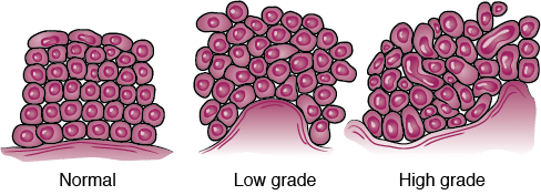 Bladder Cancer Types, Stages, & Bladder Cancer Grades