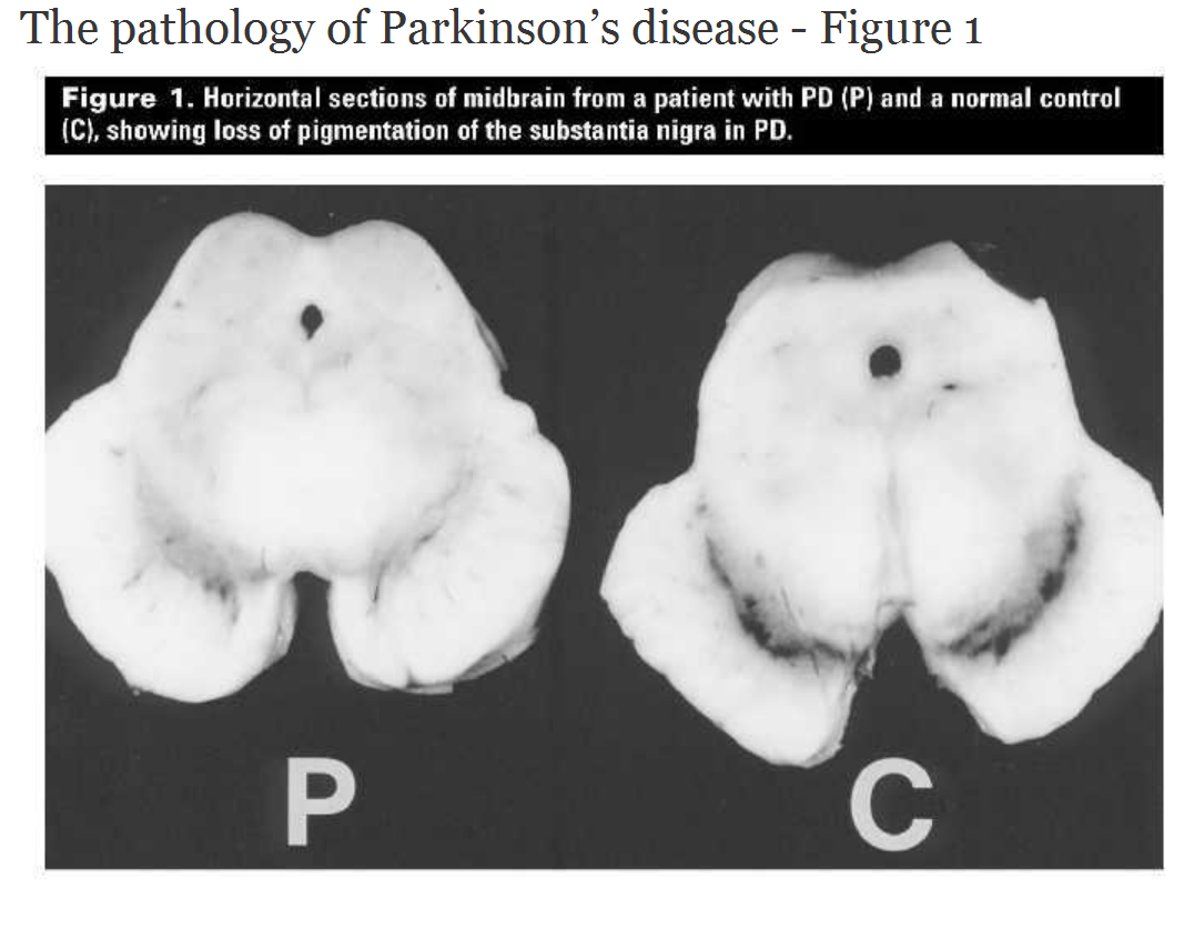 The pathology of Parkinson’s disease British Columbia Medical Journal