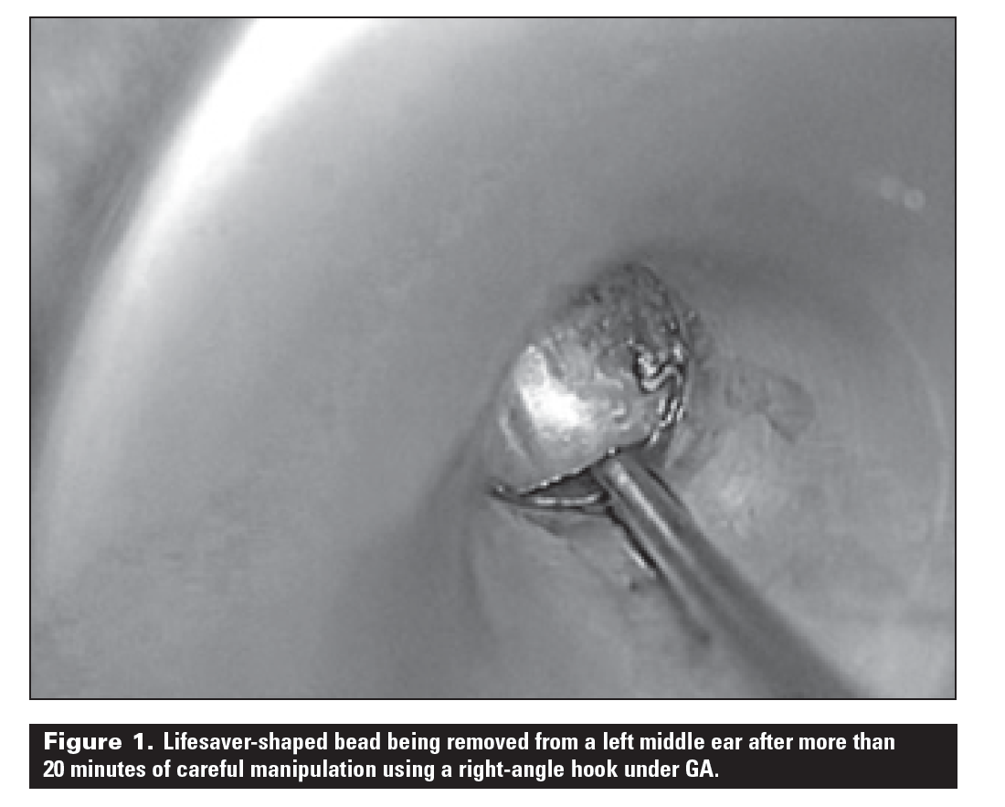 Removal of ear canal foreign bodies in children What can go wrong and