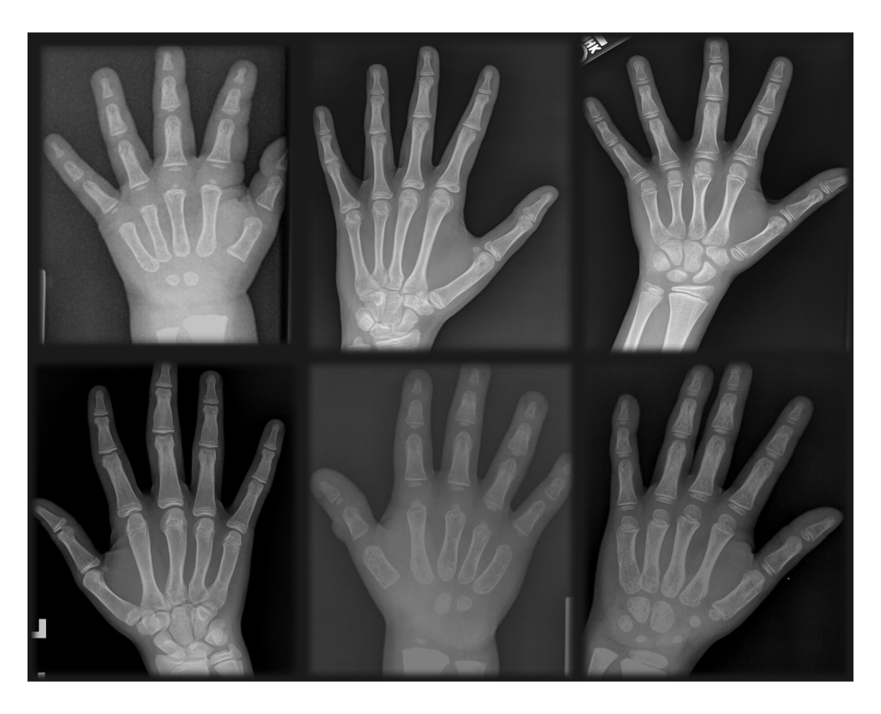 Bone Age Assessment Resources
