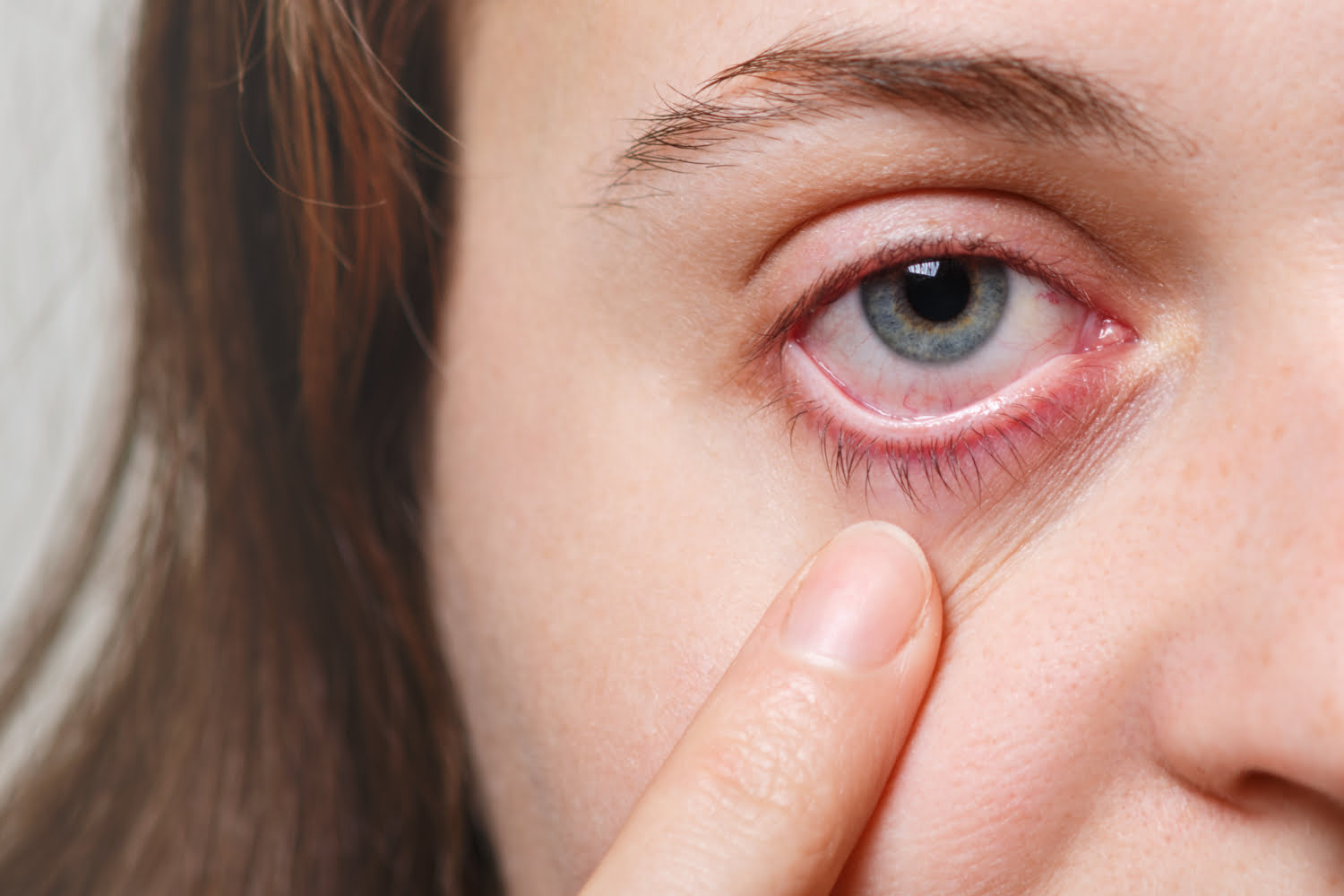 Dry Eye Syndrome Treatment Options Langley Eyecare Centre