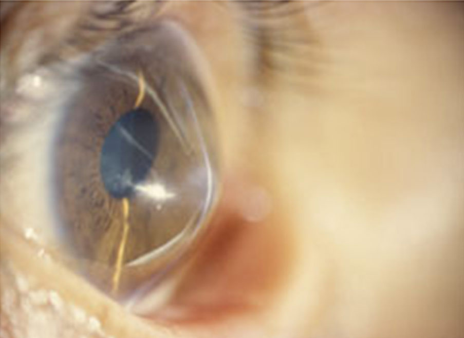 Keratoconus Treatment, CA Blurry Vision Treatment, Orange County