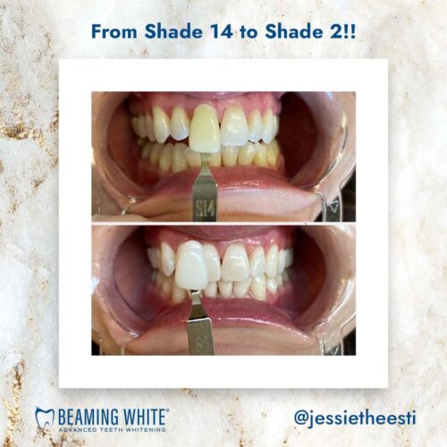 How to Whiten Teeth FAST (in 2022) Beaming White Teeth Whitening