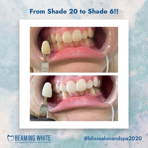 How to Whiten Teeth FAST (in 2022) Beaming White Teeth Whitening