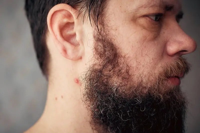 Do Acne Products Affect Facial Hair Growth?