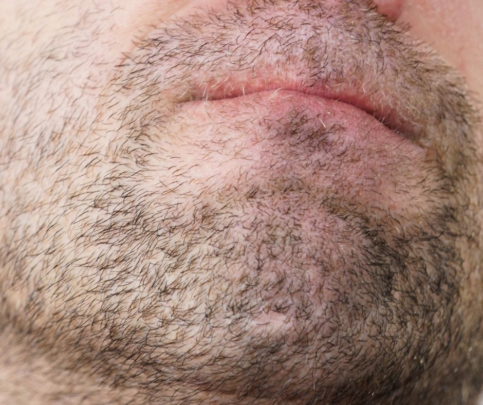 How To Get Facial Hair To Stop Growing?