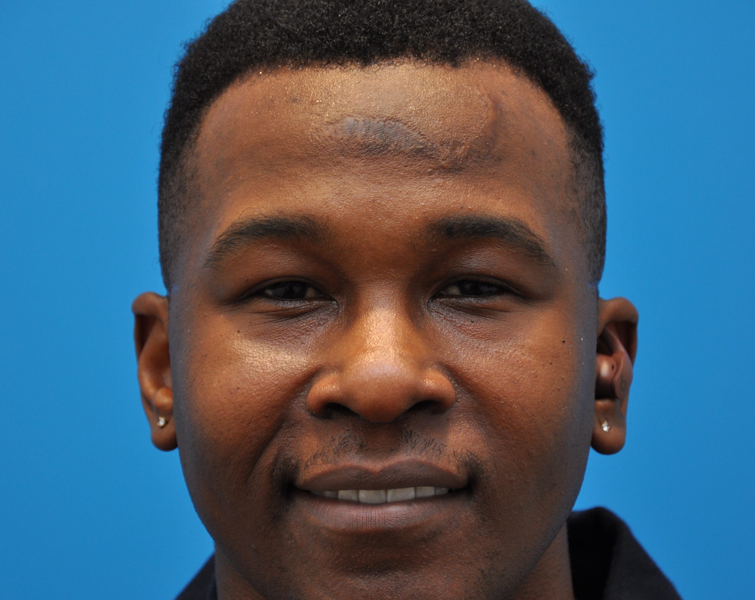 scar revision & microneedling Case 13483 Beaty Facial Plastic Surgery