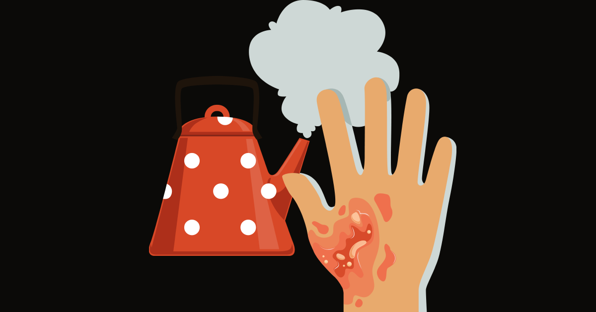 Identifying a Severe Burn Beaumont Emergency Hospital