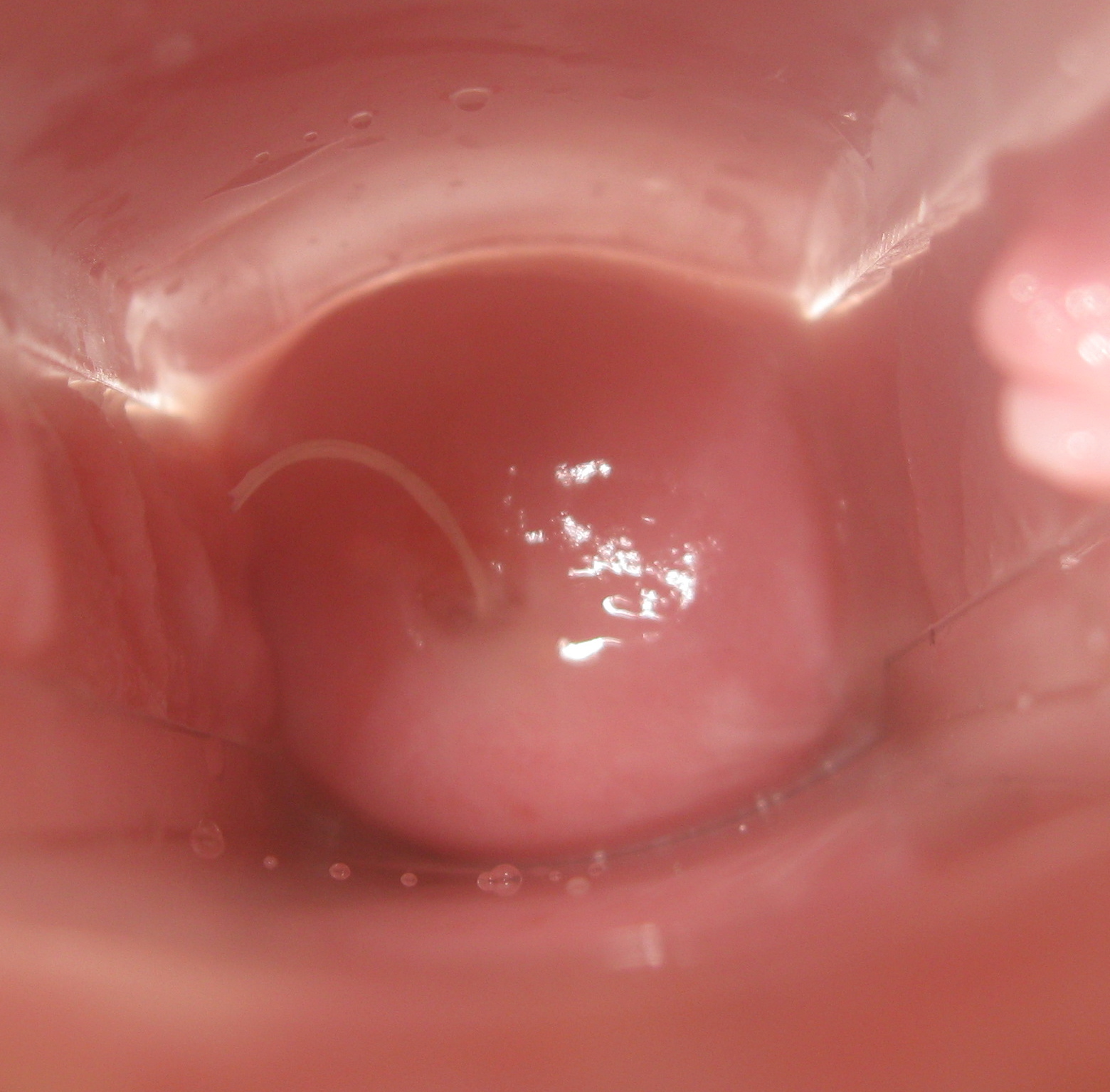 Age 25 Entire Cycle with IUD Beautiful Cervix Project