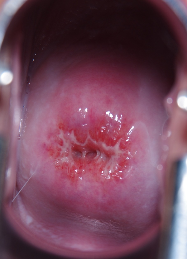 Age 30 Entire Cycle Beautiful Cervix Project
