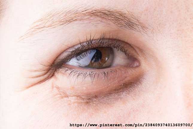 Dark Eyelids 17 Ways to Treat Dark Eyelids Through Home Remedies