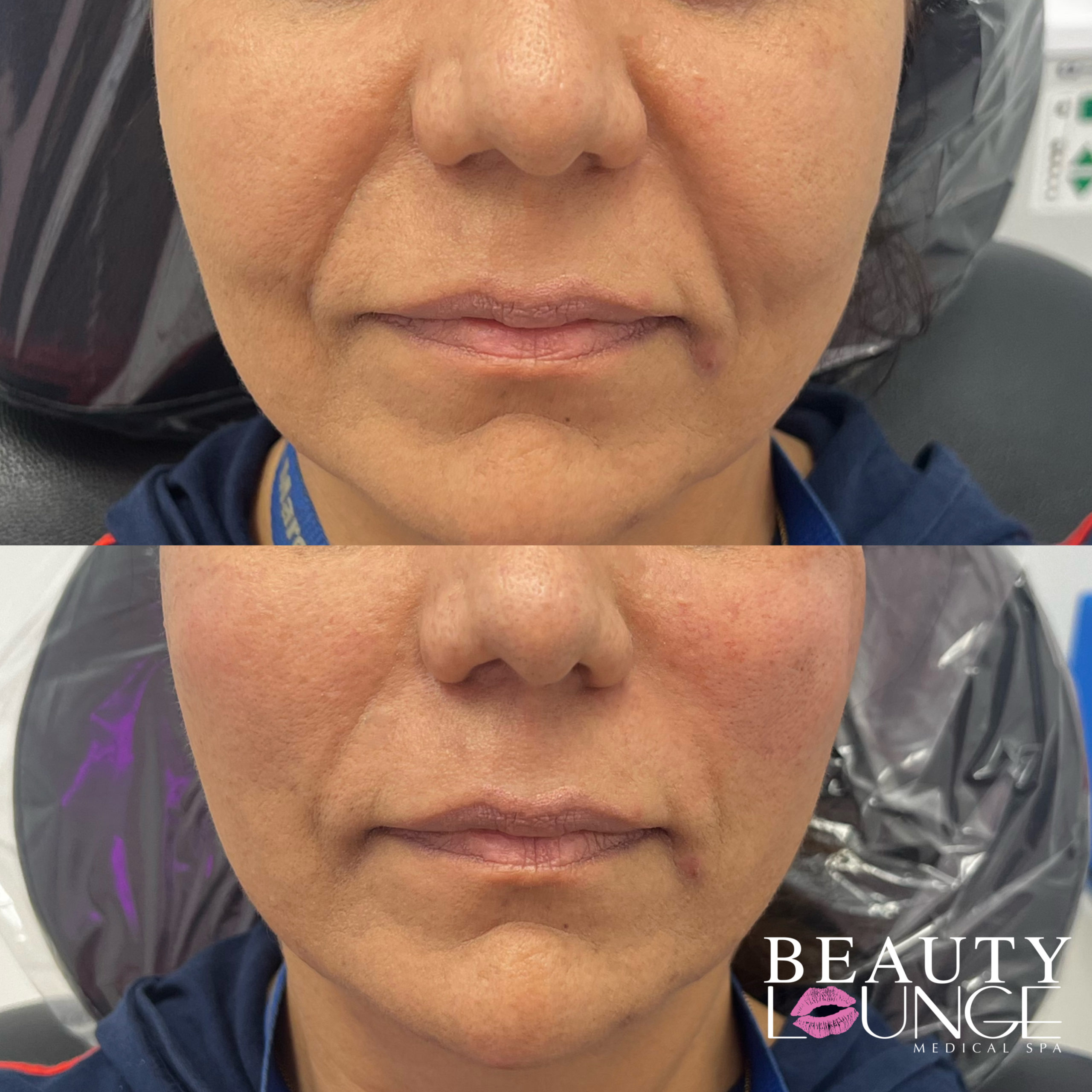 PDO Thread Lift San Diego Polydioxanone threads NonSurgical Facelift
